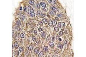 IHC analysis of FFPE human lung carcinoma tissue stained with Aldolase antibody (ALDOA antibody  (AA 66-95))