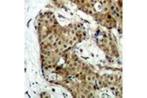 Immunohistochemical analysis of GAPDH staining in human breast cancer formalin fixed paraffin embedded tissue section. (GAPDH antibody)