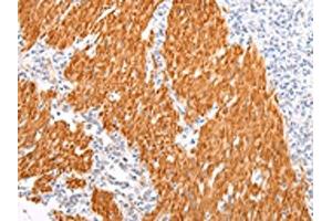 The image on the left is immunohistochemistry of paraffin-embedded Human gastric cancer tissue using ABIN7190022(BSN Antibody) at dilution 1/20, on the right is treated with synthetic peptide.