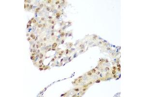 Immunohistochemistry of paraffin-embedded human lung cancer using CDK1 antibody. (CDK1 antibody  (AA 1-297))