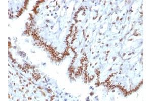 Formalin-fixed, paraffin-embedded human Endometrial Carcinoma stained with TLE1 Mouse Monoclonal Antibody (TLE1/2085). (TLE1 antibody  (AA 175-338))
