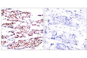 Immunohistochemical analysis of paraffin-embedded breast carcinoma. (JunB antibody  (pSer79))