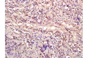 Formalin-fixed and paraffin embedded human lung carcinoma labeled with Anti-WNT9A Polyclonal Antibody, Unconjugated (ABIN675533) at 1:200 followed by conjugation to the secondary antibody and DAB staining