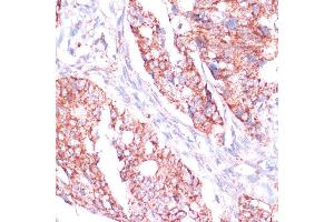 Immunohistochemistry of paraffin-embedded human colon carcinoma using RPL24 antibody (ABIN7269998) at dilution of 1:100 (40x lens). (RPL24 antibody  (AA 38-157))