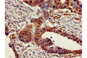 Immunohistochemistry of paraffin-embedded human colon cancer using ABIN7142959 at dilution of 1:100 (CHRNB1 antibody  (AA 24-244))