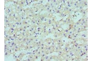 Immunohistochemistry of paraffin-embedded human liver cancer using ABIN7147709 at dilution of 1:100 (CBX8 antibody  (AA 80-280))