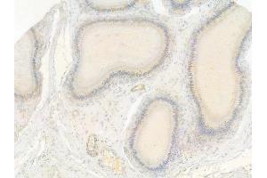 ABIN7093391 and ABIN7097412 at 1/100 staining human testicular cancer by IHC-P.