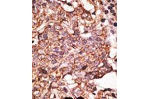 Formalin-fixed and paraffin-embedded human cancer tissue reacted with the primary antibody, which was peroxidase-conjugated to the secondary antibody, followed by AEC staining. (SIGLEC6 antibody  (C-Term))