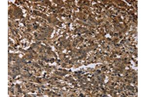 The image on the left is immunohistochemistry of paraffin-embedded Human liver cancer tissue using ABIN7191451(MFF Antibody) at dilution 1/25, on the right is treated with synthetic peptide. (MFF antibody)