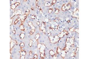 Immunohistochemistry of paraffin-embedded Human liver cancer using CD36 Polyclonal Antibody at dilution of 1:200 (40x lens). (CD36 antibody)