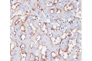 Immunohistochemistry of paraffin-embedded Human liver cancer using CD36 Polyclonal Antibody at dilution of 1:200 (40x lens).