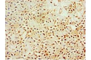 Immunohistochemistry of paraffin-embedded human breast cancer using ABIN7161640 at dilution of 1:100 (KLRC1 antibody  (AA 114-233))
