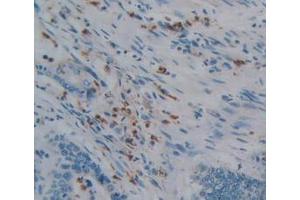 IHC-P analysis of Human Rectum Cancer Tissue, with DAB staining. (PTPRQ antibody  (AA 36-294))