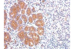 IHC-P Image CCKBR antibody [C1C2], Internal detects CCKBR protein at membrane on human colon carcinoma by immunohistochemical analysis. (CCKBR antibody  (C-Term))