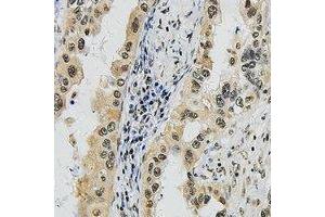 Immunohistochemical analysis of SUPT16H staining in human lung cancer formalin fixed paraffin embedded tissue section. (SUPT16H antibody  (C-Term))