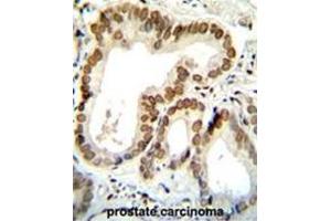 BTG2 Antibody (N-term) immunohistochemistry analysis in formalin fixed and paraffin embedded human prostate carcinoma followed by peroxidase conjugation of the secondary antibody and DAB staining. (BTG2 antibody  (N-Term))