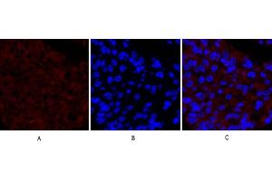 Immunofluorescence analysis of human liver cancer tissue. (PTGS2 antibody  (AA 530-610))