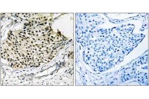 Immunohistochemistry analysis of paraffin-embedded human breast carcinoma, using IKK-gamma (Phospho-Ser31) Antibody. (IKBKG antibody  (pSer31))