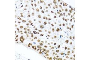 Immunohistochemistry of paraffin-embedded human lung cancer using METTL3 antibody. (METTL3 antibody  (AA 1-156))