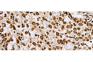 Immunohistochemistry of paraffin-embedded Human esophagus cancer tissue using MYEF2 Polyclonal Antibody at dilution of 1:70(x200) (MYEF2 antibody)