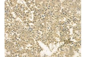 ABIN6262802 and ABIN6273129 at 1/100 staining human pituitary adenoma by IHC-P.