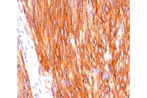 Formalin-paraffin human gastrointestinal stromal tumor (GIST) stained with CD117 antibody (C117/370). (KIT antibody)