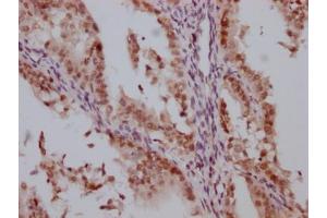 IHC image of ABIN7127539 diluted at 1:100 and staining in paraffin-embedded human endometrial cancer performed on a Leica BondTM system. (Recombinant HDAC3 antibody)
