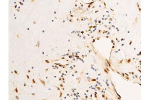 ABIN6267303 at 1/100 staining human glioma tissue sections by IHC-P.