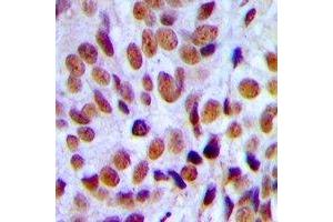 Immunohistochemical analysis of RUNX1 staining in human breast cancer formalin fixed paraffin embedded tissue section. (RUNX1 antibody)