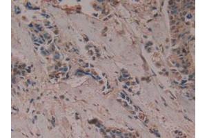 Detection of PTGDS in Human Breast Cancer Tissue using Polyclonal Antibody to Prostaglandin-H2 D-isomerase (PTGDS) (PTGDS antibody  (AA 32-190))