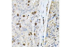 Immunohistochemistry of paraffin-embedded human prostate cancer using PNKP antibody.
