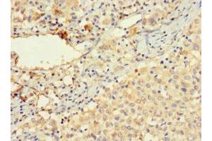 Immunohistochemistry of paraffin-embedded human lung cancer using ABIN7175557 at dilution of 1:100 (Vitronectin antibody  (AA 31-105))
