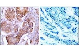 Immunohistochemistry analysis of paraffin-embedded human breast carcinoma, using Estrogen Receptor-alpha (Phospho-Ser106) Antibody. (Estrogen Receptor alpha antibody  (pSer106))