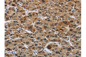 The image on the left is immunohistochemistry of paraffin-embedded Human liver cancer tissue using ABIN7191086(IL31 Antibody) at dilution 1/20, on the right is treated with synthetic peptide. (IL-31 antibody)