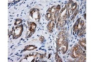 Immunohistochemical staining of paraffin-embedded Carcinoma of liver tissue using anti-SIL1 mouse monoclonal antibody.