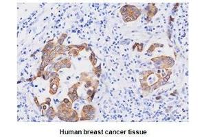 Paraffin embedded sections of human breast canitrocelluloseer tissue were initrocelluloseubated with anti-human FADD (1:50) for 2 hours at room temperature. (FADD antibody  (AA 1-208))