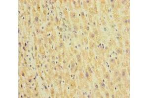 Immunohistochemistry of paraffin-embedded human liver cancer using ABIN7155002 at dilution of 1:100 (HEPACAM2 antibody  (AA 32-351))
