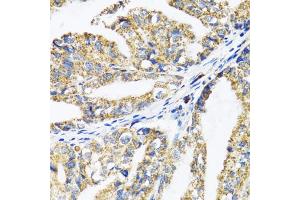 Immunohistochemistry of paraffin-embedded human gastric cancer using EPB41 antibody (ABIN1872554) at dilution of 1:100 (40x lens). (EPB41 antibody)