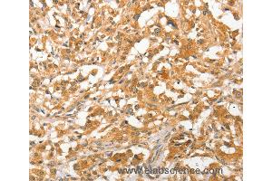 Immunohistochemistry of Human liver cancer using APTX Polyclonal Antibody at dilution of 1:50