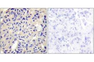 Immunohistochemistry analysis of paraffin-embedded human breast carcinoma tissue, using Collagen V alpha2 Antibody. (COL5A2 antibody  (AA 1-50))