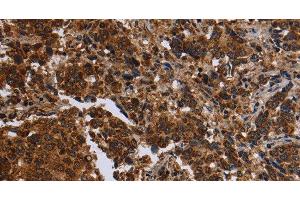 Immunohistochemistry of paraffin-embedded Human liver cancer tissue using FMN2 Polyclonal Antibody at dilution 1:30