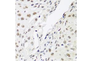 Immunohistochemistry of paraffin-embedded human lung cancer using CBX3 antibody. (CBX3 antibody)