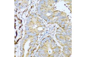 Immunohistochemistry of paraffin-embedded human colon carcinoma using CSH1 antibody at dilution of 1:100 (40x lens).