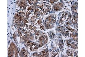 Immunohistochemical staining of paraffin-embedded Carcinoma of prostate tissue using anti-RC201933 mouse monoclonal antibody. (PIM2 antibody)