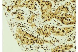 ABIN6275527 at 1/100 staining Human breast cancer tissue by IHC-P. (STK24 antibody  (N-Term))