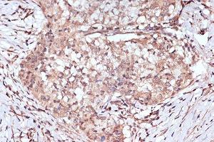 Immunohistochemistry of paraffin-embedded human esophageal cancer using B Rabbit mAb (ABIN7265849) at dilution of 1:100 (40x lens). (BAG2 antibody)