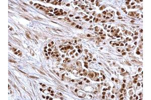 IHC-P Image Rb antibody detects Rb protein at nucleus on human colon carcinoma by immunohistochemical analysis.