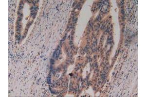 IHC-P analysis of Human Rectum Cancer Tissue, with DAB staining. (Caspase 8 antibody  (AA 7-216))