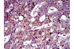Immunohistochemical analysis of paraffin-embedded esophageal cancer tissues using MRPL42 mouse mAb with DAB staining. (MRPL42 antibody  (AA 10-142))