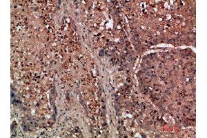 Immunohistochemical analysis of paraffin-embedded human-lung-cancer, antibody was diluted at 1:200 (DDR2 antibody  (AA 31-80))
